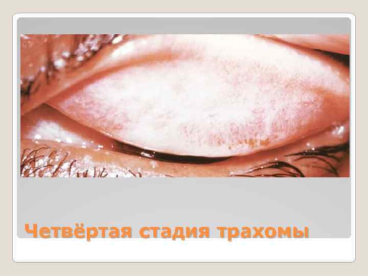 Четвёртая стадия трахомы 