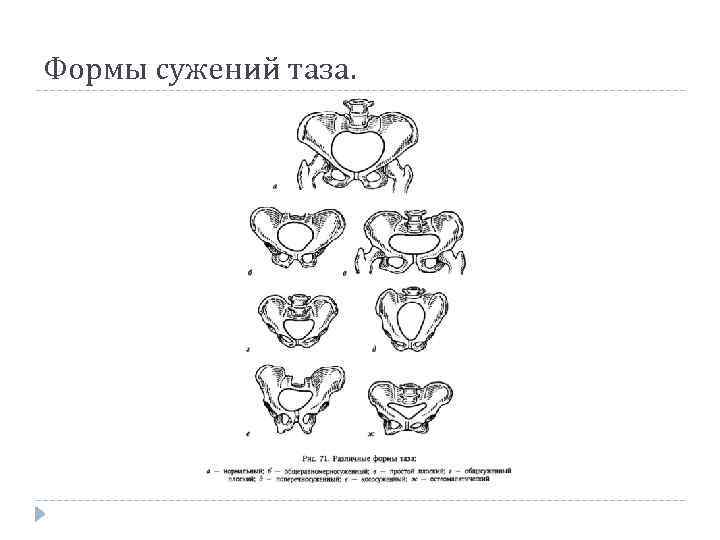 Формы сужений таза. 