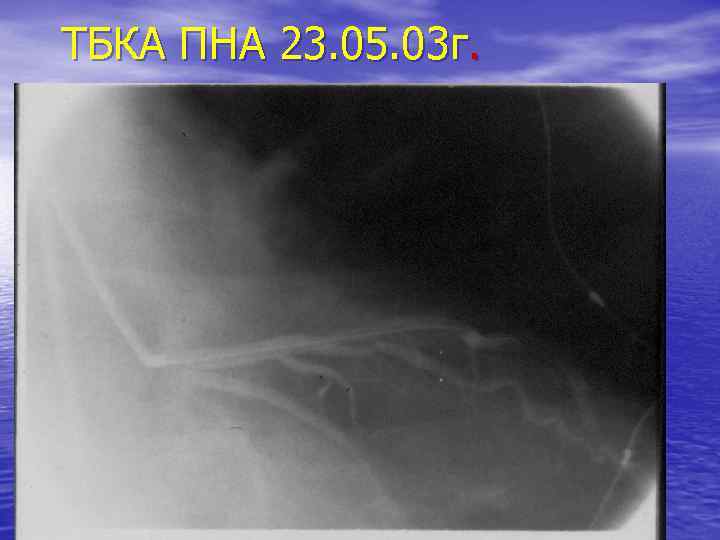 ТБКА ПНА 23. 05. 03 г. 