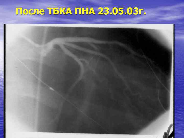 После ТБКА ПНА 23. 05. 03 г. 