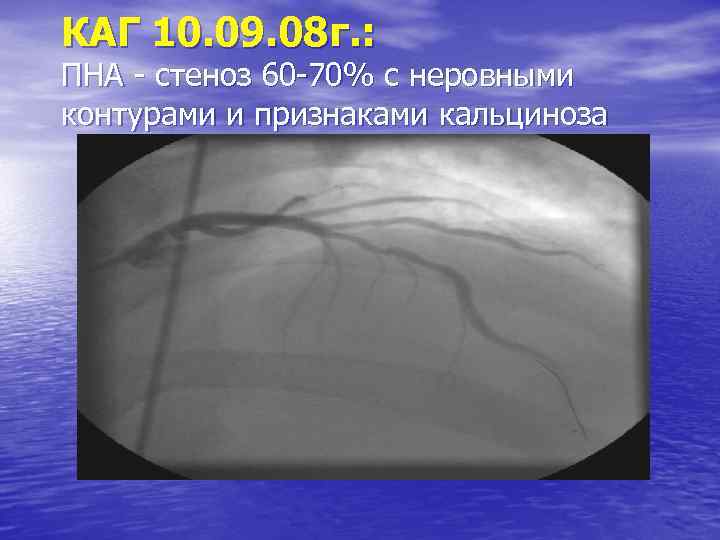 КАГ 10. 09. 08 г. : ПНА - стеноз 60 -70% с неровными контурами