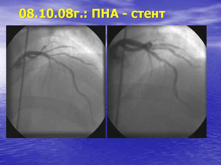 08. 10. 08 г. : ПНА - стент 