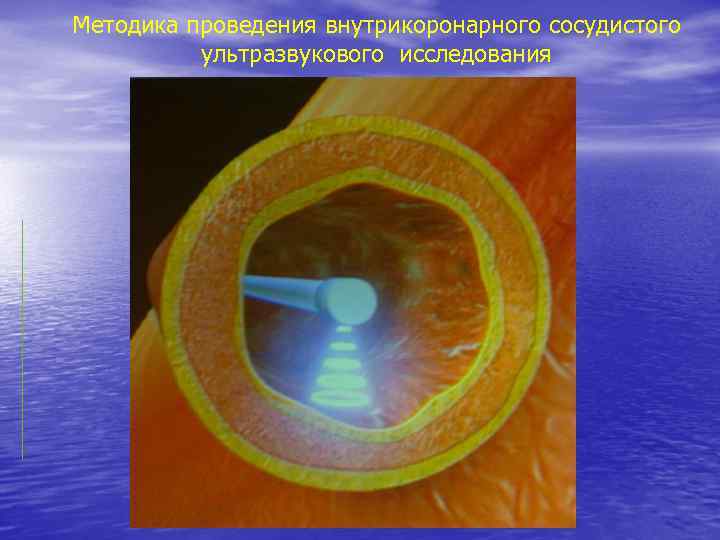 Методика проведения внутрикоронарного сосудистого ультразвукового исследования 