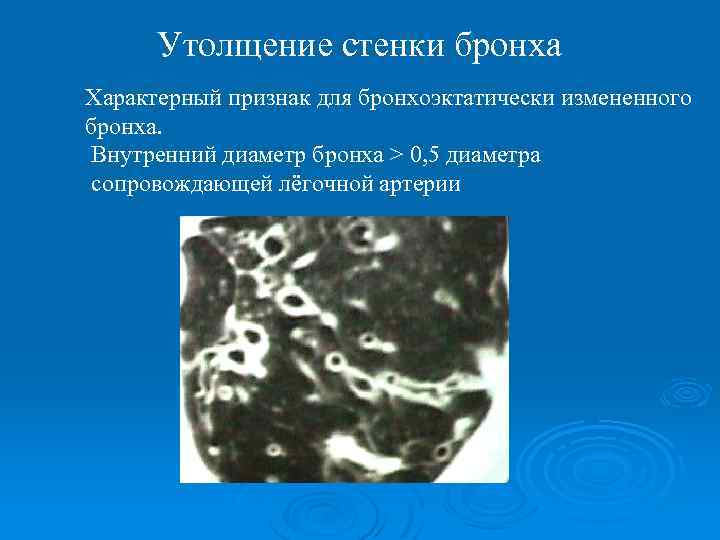 Утолщение стенки бронха Характерный признак для бронхоэктатически измененного бронха. Внутренний диаметр бронха > 0,