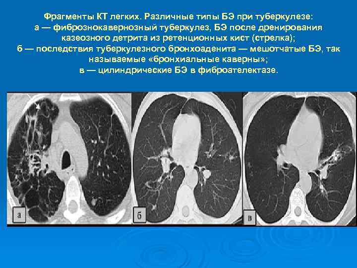 Фрагменты КТ легких. Различные типы БЭ при туберкулезе: а — фибрознокавернозный туберкулез, БЭ после