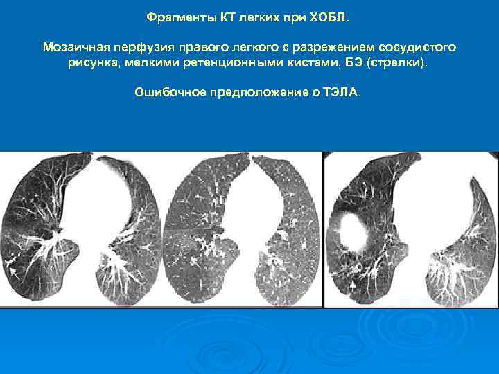 Отек легких картина кт