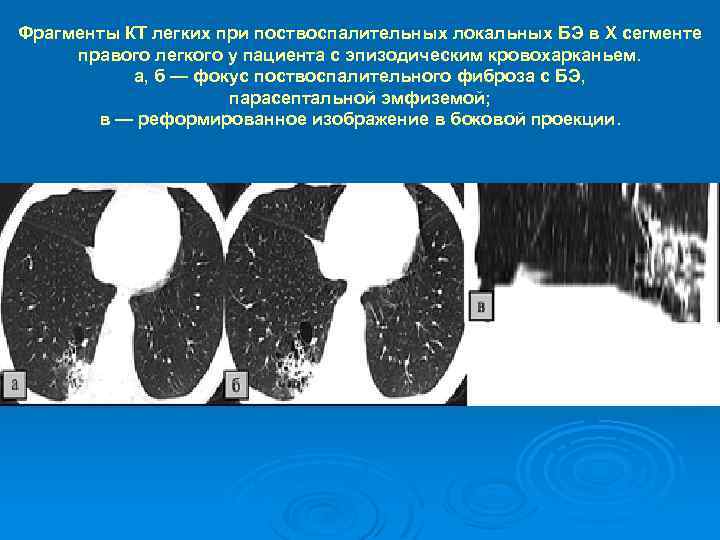 Фрагменты КТ легких при поствоспалительных локальных БЭ в Х сегменте правого легкого у пациента