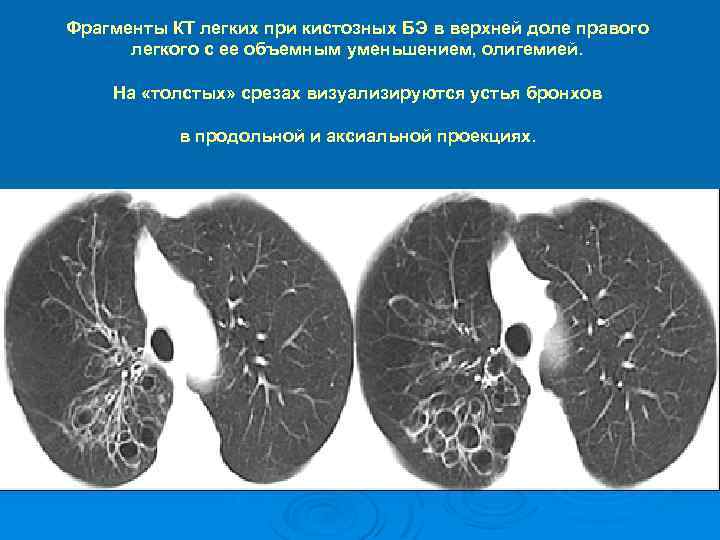 Фрагменты КТ легких при кистозных БЭ в верхней доле правого легкого с ее объемным
