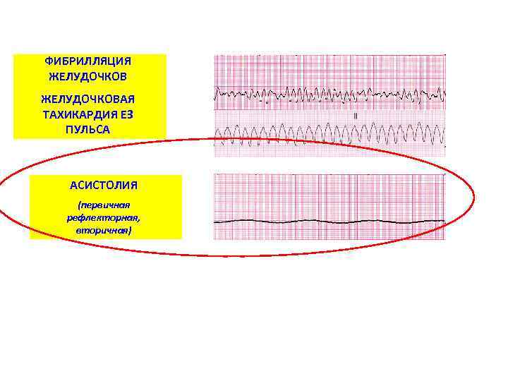 ФИБРИЛЛЯЦИЯ ЖЕЛУДОЧКОВАЯ ТАХИКАРДИЯ ЕЗ ПУЛЬСА АСИСТОЛИЯ (первичная рефлекторная, вторичная) 