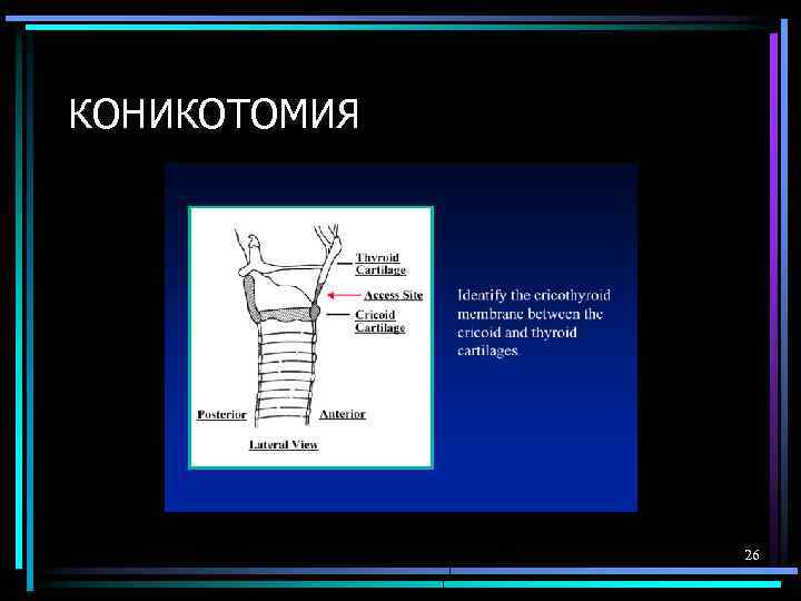КОНИКОТОМИЯ 26 