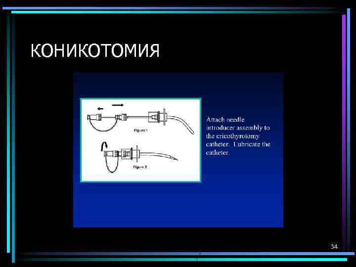 КОНИКОТОМИЯ 34 
