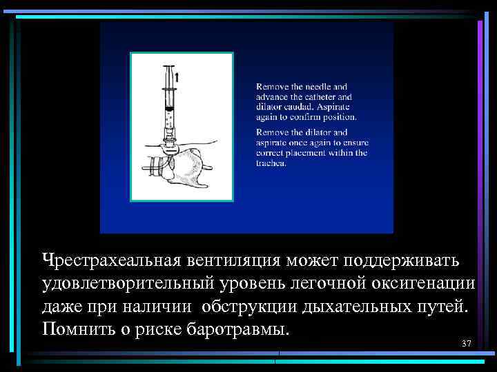 Чрестрахеальная вентиляция может поддерживать удовлетворительный уровень легочной оксигенации даже при наличии обструкции дыхательных путей.