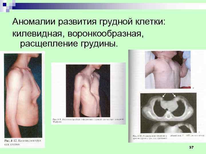 Аномалии развития грудной клетки: килевидная, воронкообразная, расщепление грудины. 37 