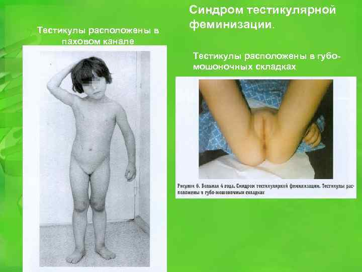Тестикулы расположены в паховом канале Синдром тестикулярной феминизации. Тестикулы расположены в губомошоночных складках 