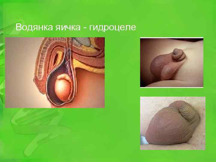 Водянка яичка - гидроцеле 