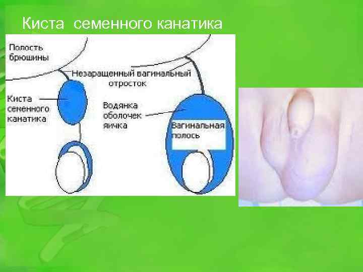 Киста семенного канатика 