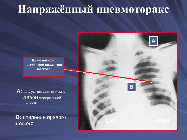 Напряжённый пневмоторакс A Край легкого частичное спадение лёгкого B A: воздух под давлением в