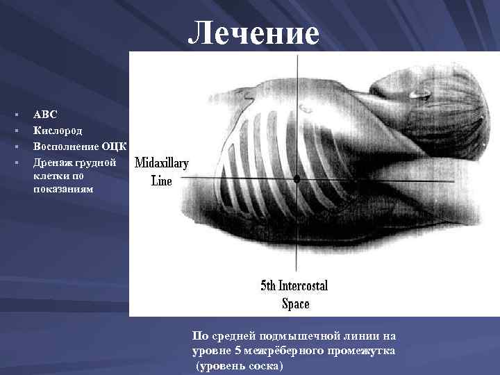 Лечение § § АВС Кислород Восполнение ОЦК Дренаж грудной клетки по показаниям По средней