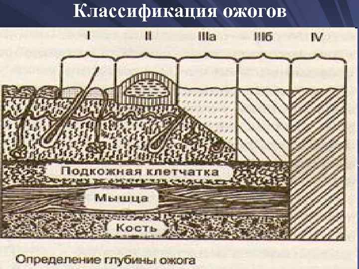 Классификация ожогов. Классификация ожогов по а. н. Орлову. Классификация ожогов, корме.