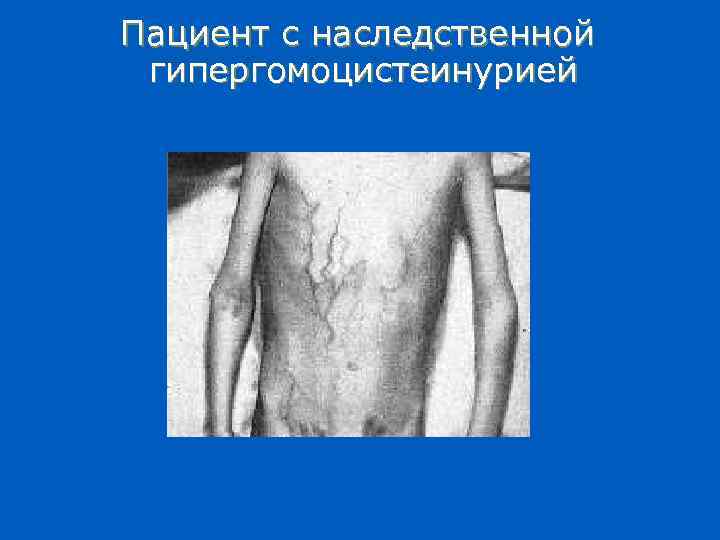 Пациент с наследственной гипергомоцистеинурией 