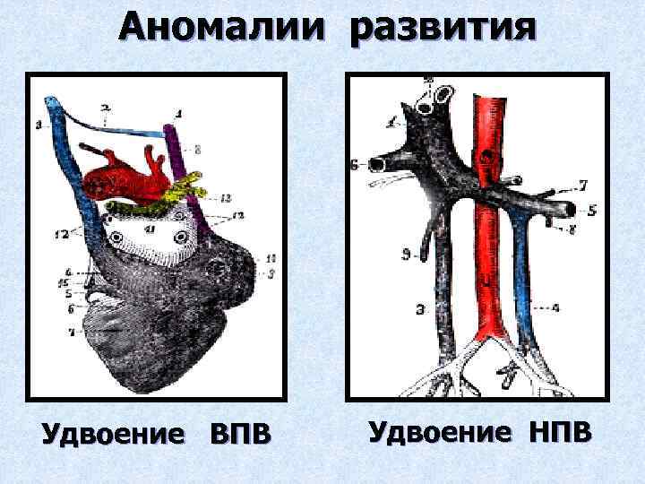 Аномалии развития Удвоение ВПВ Удвоение НПВ 