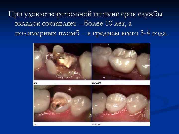 При удовлетворительной гигиене срок службы вкладок составляет – более 10 лет, а полимерных пломб