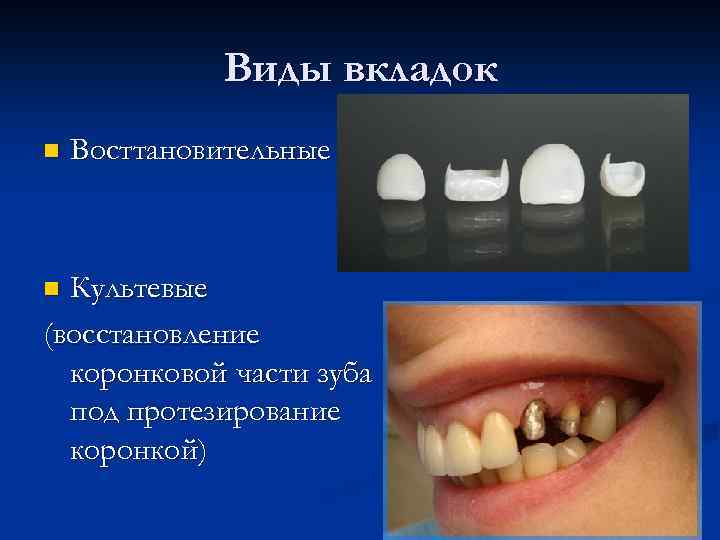 Виды вкладок n Восттановительные Культевые (восстановление коронковой части зуба под протезирование коронкой) n 