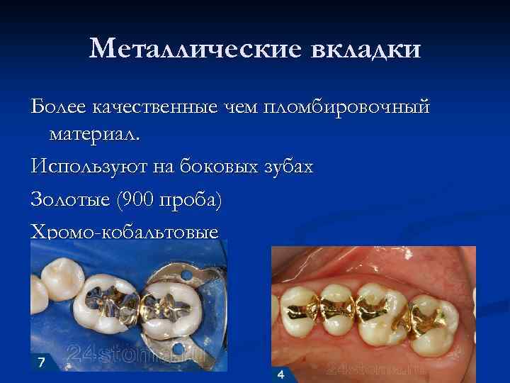 Металлические вкладки Более качественные чем пломбировочный материал. Используют на боковых зубах Золотые (900 проба)