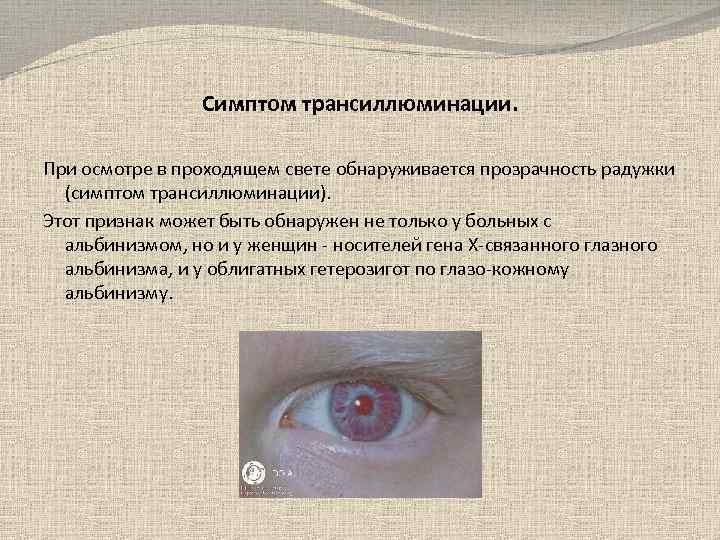 Симптом трансиллюминации. При осмотре в проходящем свете обнаруживается прозрачность радужки (симптом трансиллюминации). Этот признак