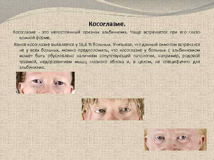 Косоглазие - это непостоянный признак альбинизма. Чаще встречается при его глазокожной форме. Явное косоглазие