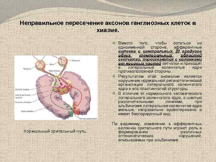 Неправильное пересечение аксонов ганглиозных клеток в хиазме. v Вместо того, чтобы остаться на одноименной