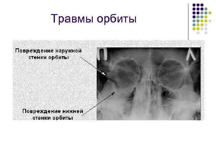 Травмы орбиты 