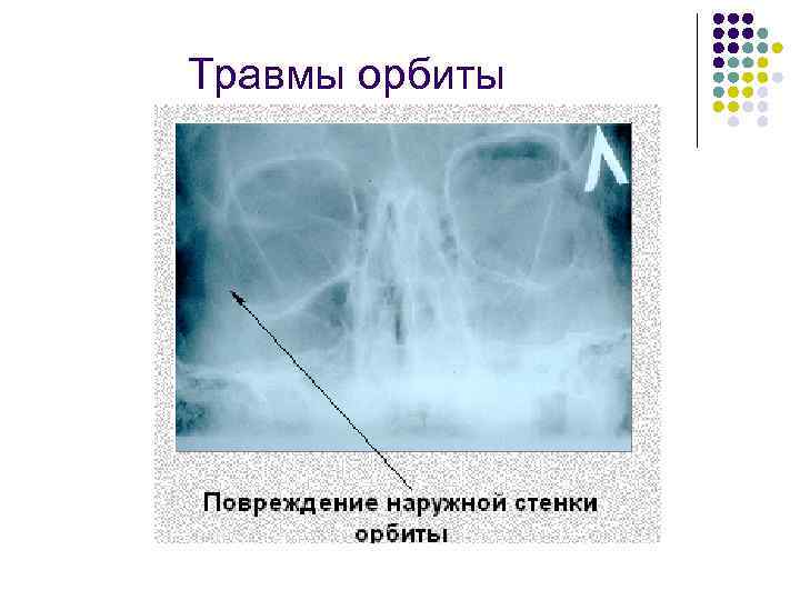 Травмы орбиты 