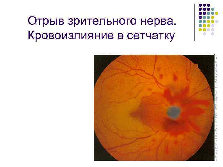 Отрыв зрительного нерва. Кровоизлияние в сетчатку 