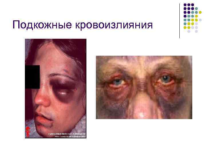 Подкожные кровоизлияния 