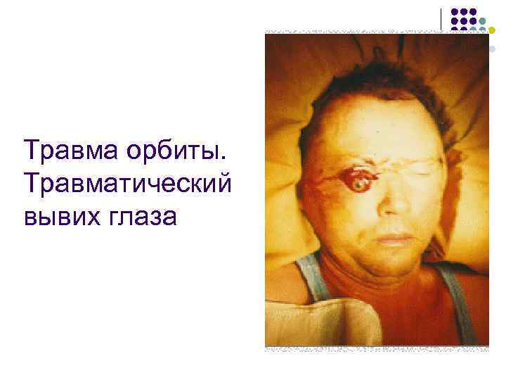 Травма орбиты. Травматический вывих глаза 