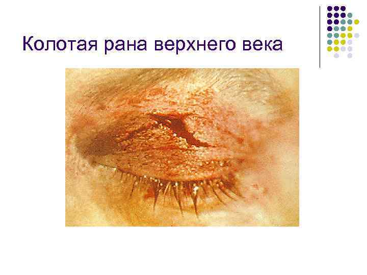 Колотая рана верхнего века 
