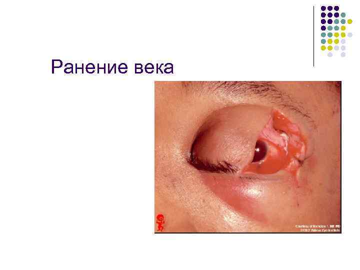 Ранение века 