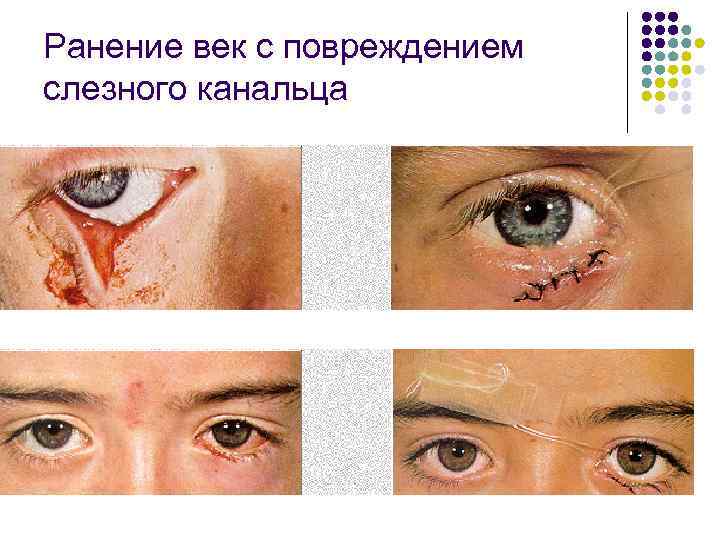 Ранение век с повреждением слезного канальца 