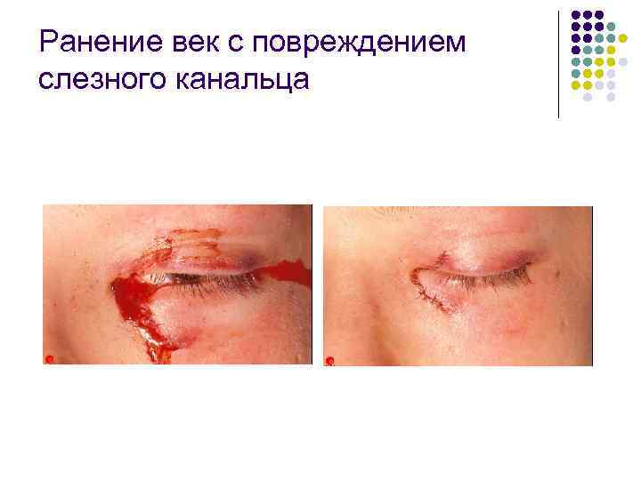 Ранение век с повреждением слезного канальца 