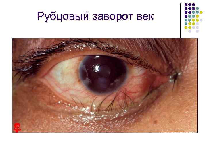 Рубцовый заворот век 