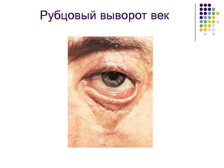 Рубцовый выворот век 