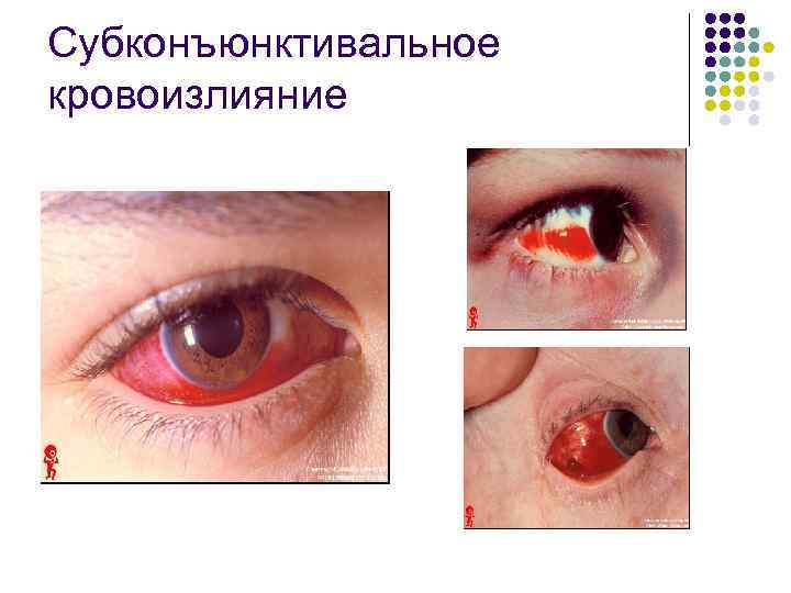Субконъюнктивальное кровоизлияние 