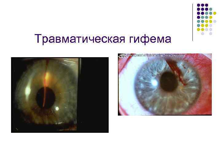 Травматическая гифема 