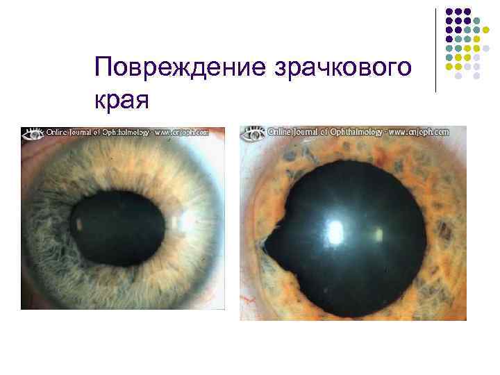 Повреждение зрачкового края 
