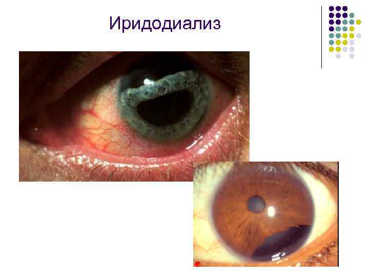 Иридодиализ 