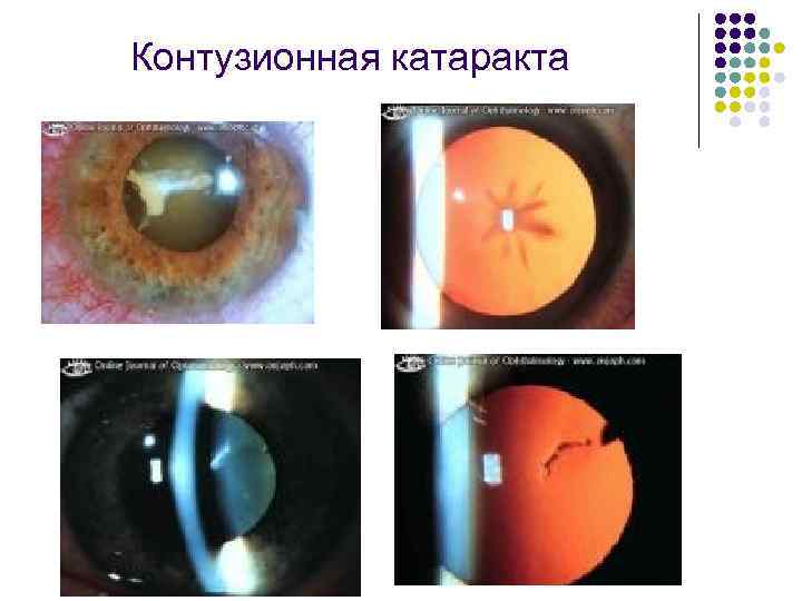 Контузионная катаракта 