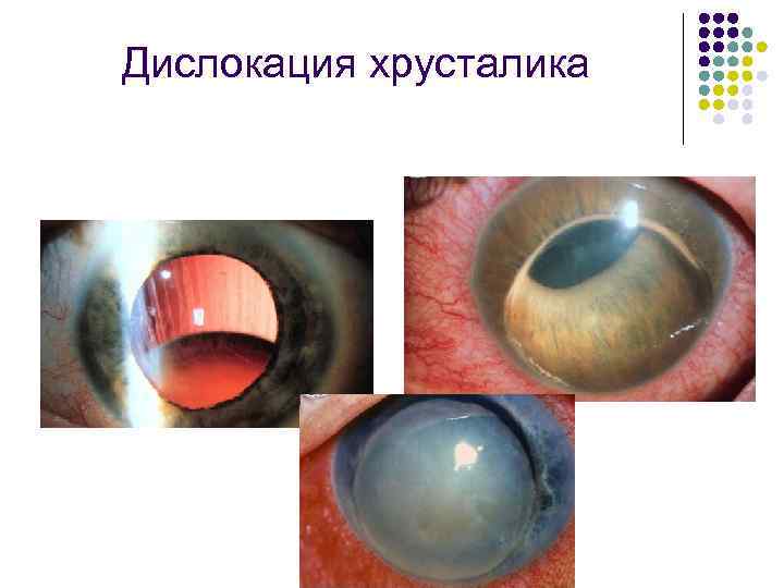Дислокация хрусталика 