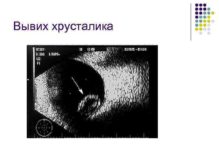 Вывих хрусталика 