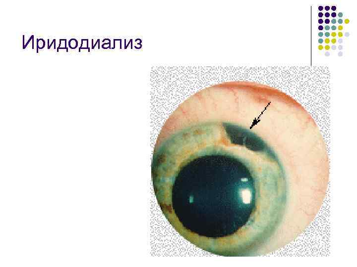 Иридодиализ 